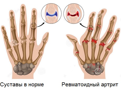 ревматоидный артрит функции щитовидной железы