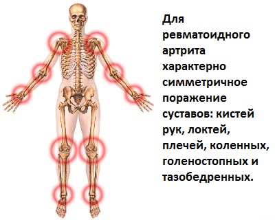 симптомы ревматоидного артрита