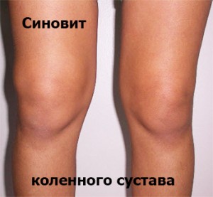 синовит при артрозе