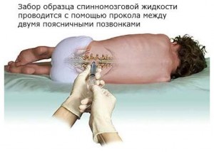 отеохондроз приводит к спинномозговой грыже