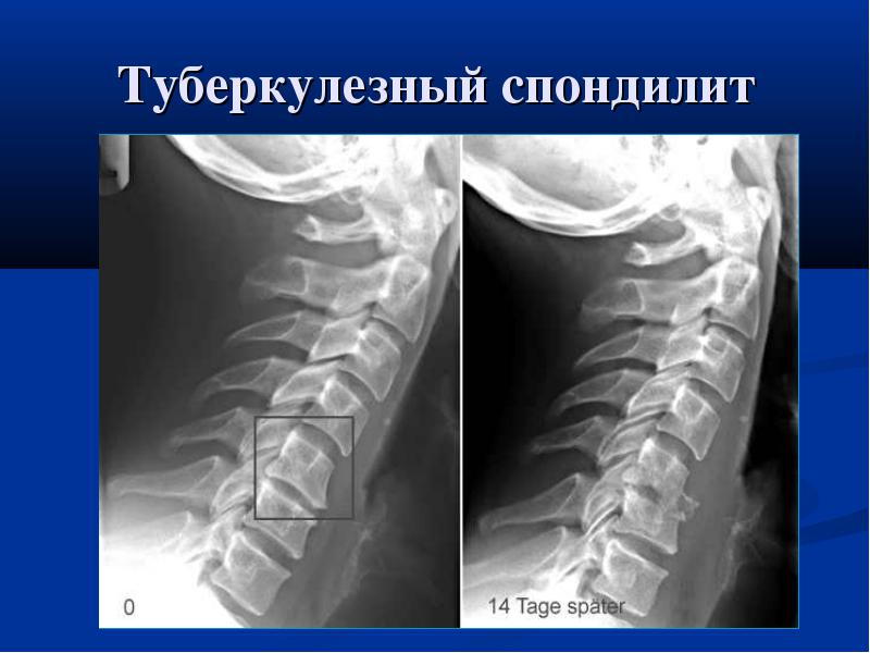 туберкулезный спондилит