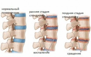 спондилит стадии