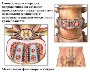  шейный спондилодез