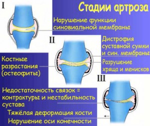 стадии артоза