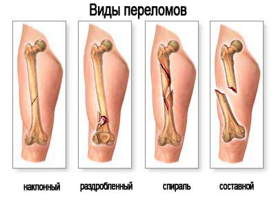 виды переломов