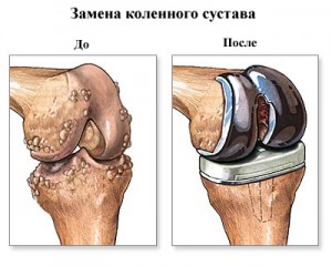 протез при артрозе