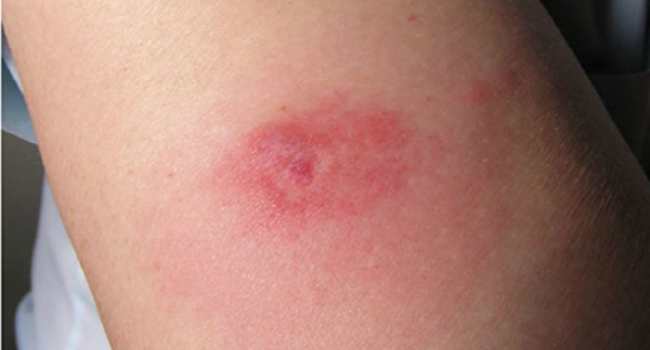 красные пятна на теле-почему появляются красные пятна на теле