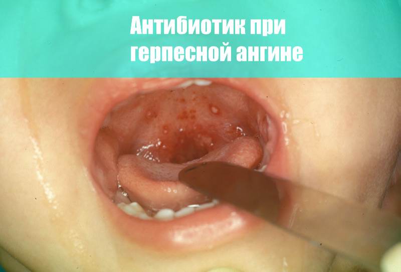 Антибиотик при герпесной ангине