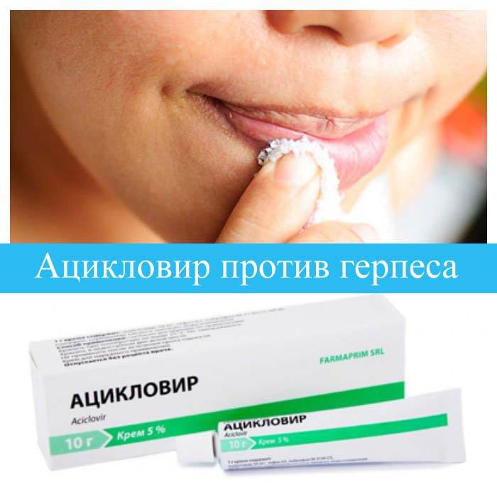 Ацикловир против герпеса