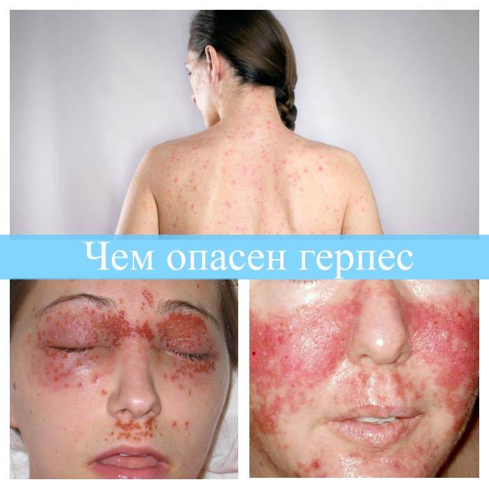 Чем опасен герпес
