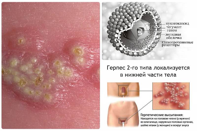 Генитальный герпес 