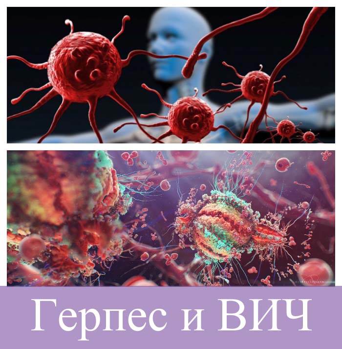 Герпес и ВИЧ