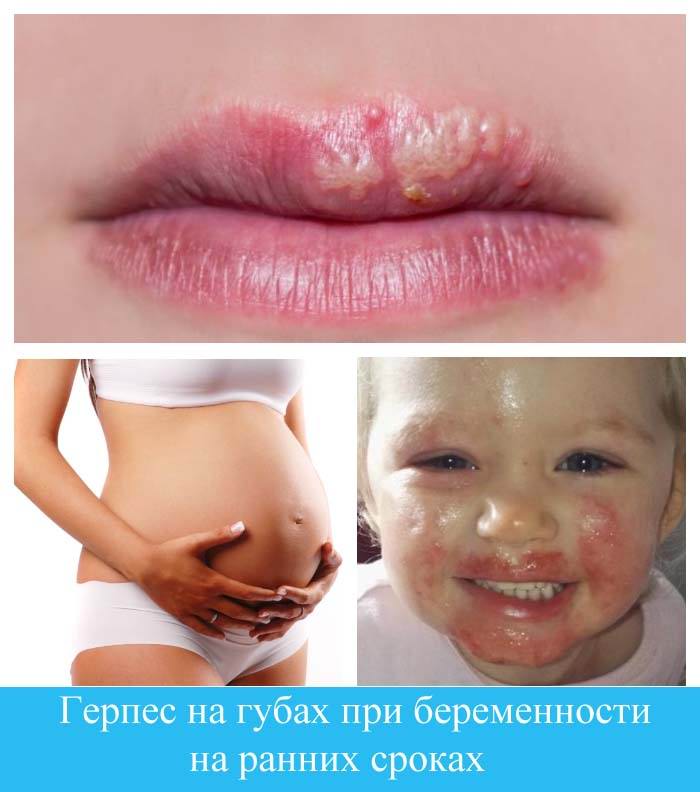 Герпес на губах при беременности на ранних сроках