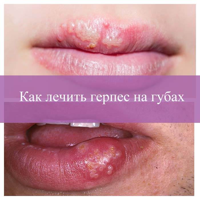 Как лечить герпес на губах