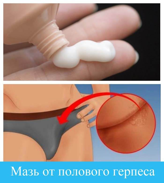 Мазь от полового герпеса