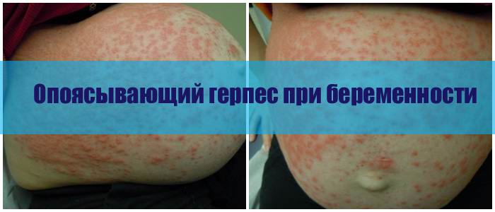 Опоясывающий герпес при беременности