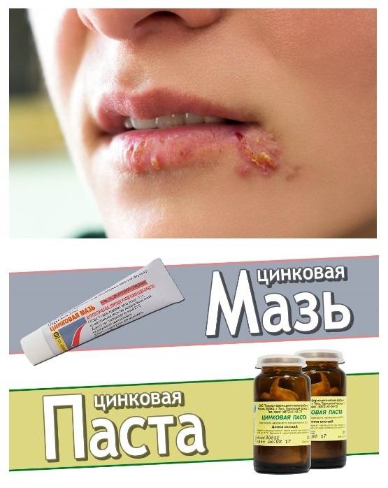 Цинковая мазь при герпесе