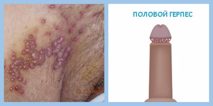 Половой герпес что это?