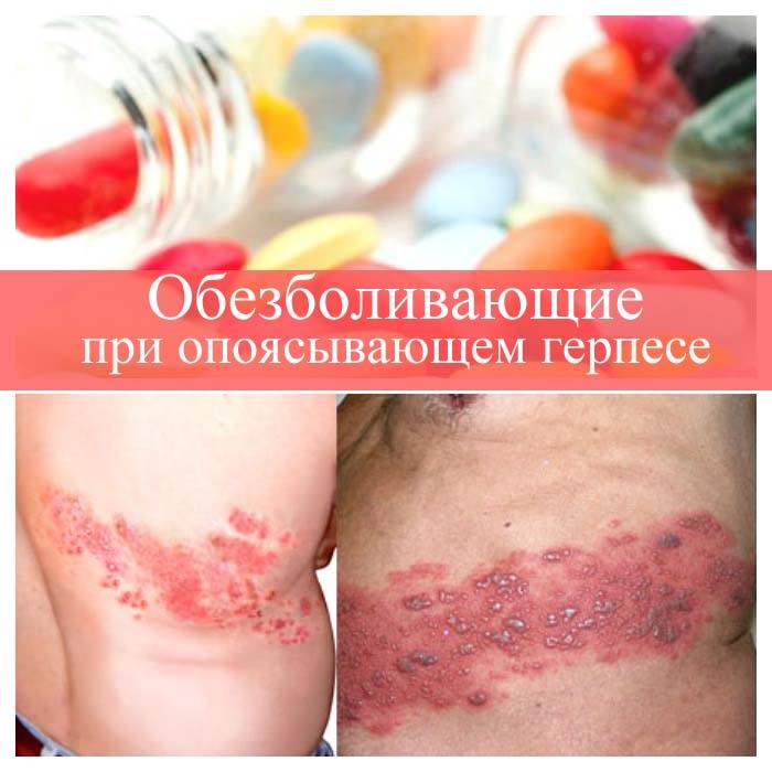 Обезболивающие при опоясывающем герпесе