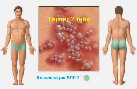 герпес 2 типа