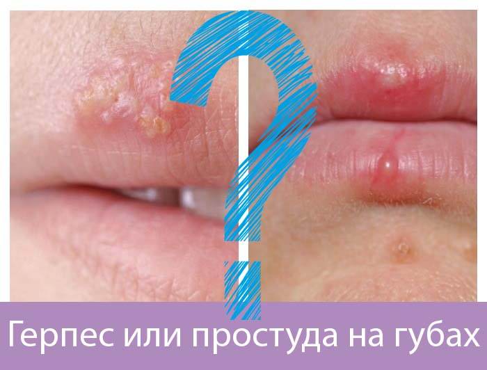герпес или простуда на губах