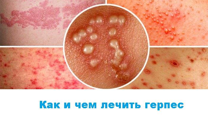 Как лечить герпес