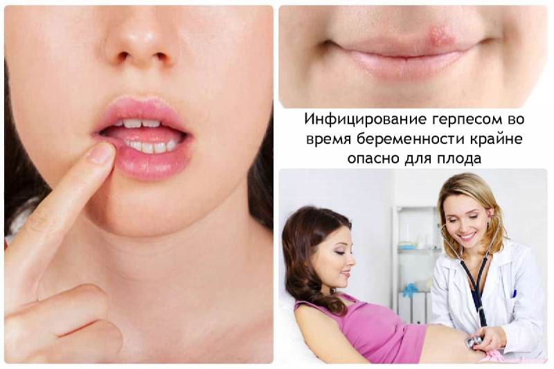 Герпес во время беременности последствия