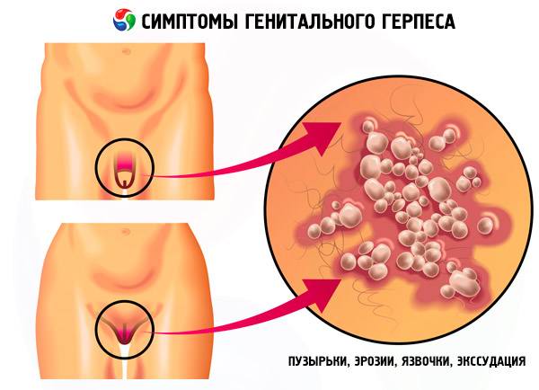 Герпес гениталий 