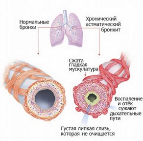 бронхи при как астматическом бронхите