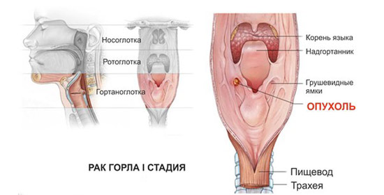 Боль в горле с одной стороны связана с неинфекционными причинами