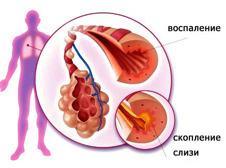 образование мокроты в бронхах