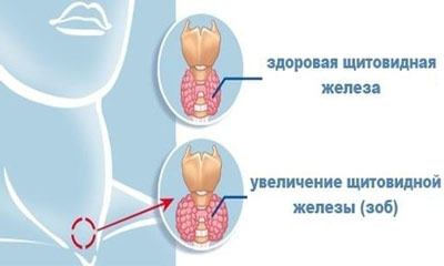 При заболевании щитовидки некоторые люди ощущают ком в горле, который мешает глотать и дышать