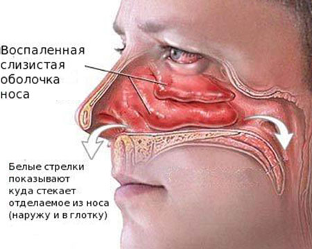 Почему в горле скапливается слизь