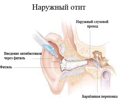 на фото показано, что представляет собой наружный отит