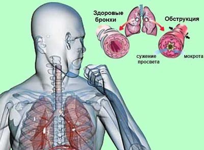 бронхит с обструкцией