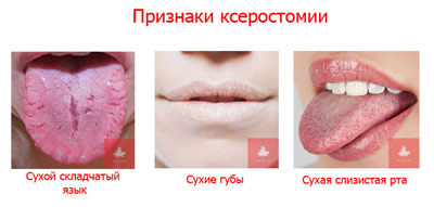Причины, вызывающие пересыхание слизистой оболочки рта