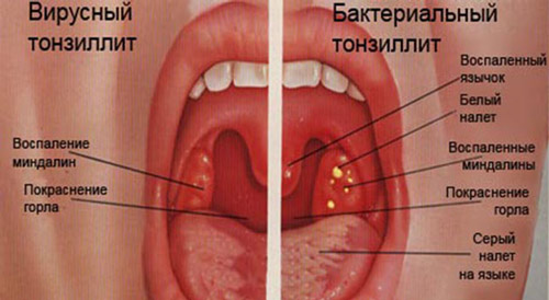 О чем может свидетельствовать боль в горле