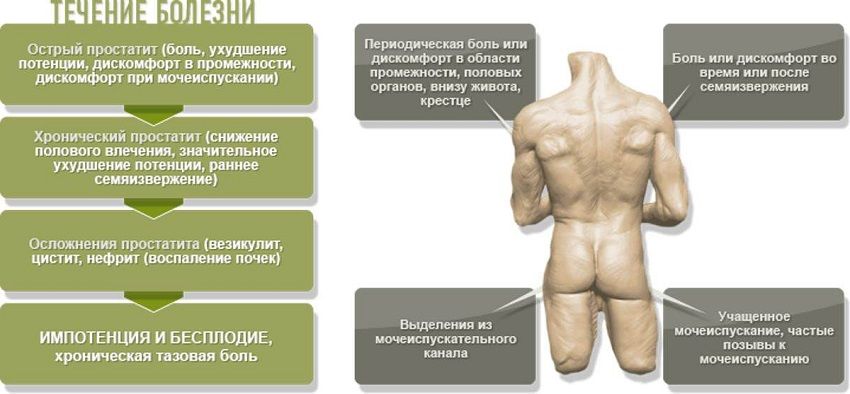 Простатит