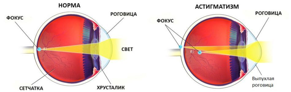 Астигматизм